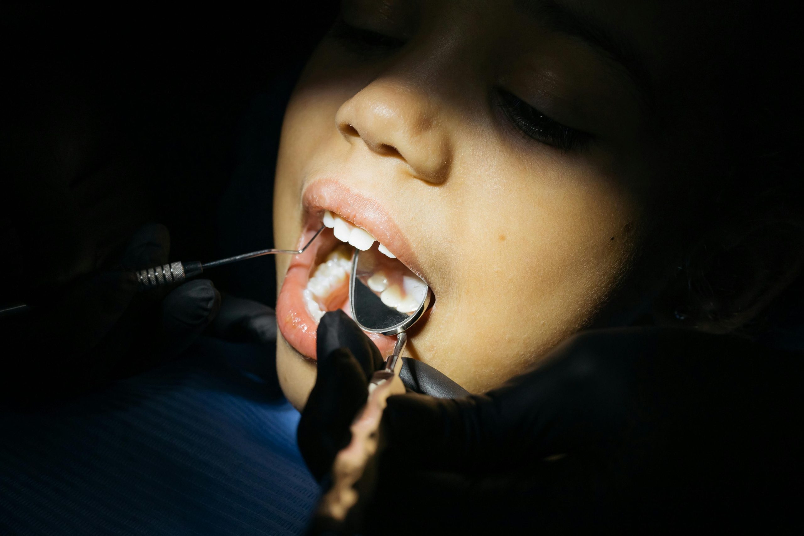 dentist's mirror in a child's mouth, showing a cavity