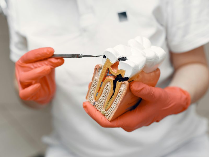 dentist using a dental model to point out a cavity